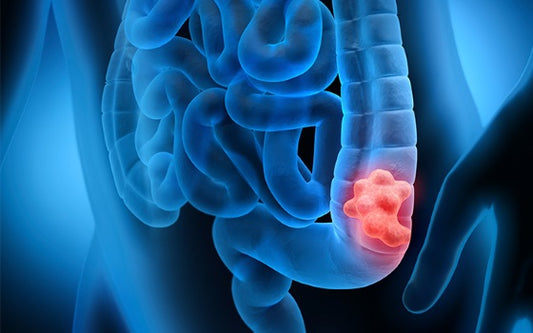 Colon cancer