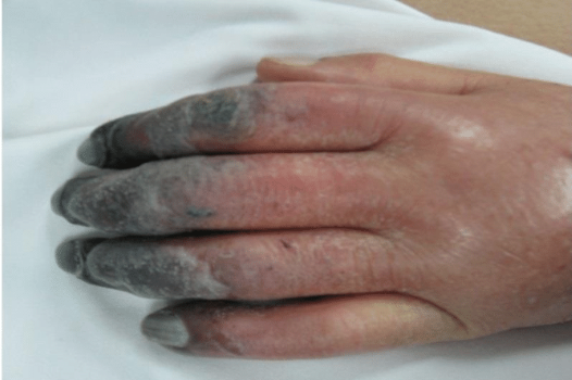 Cyanosis