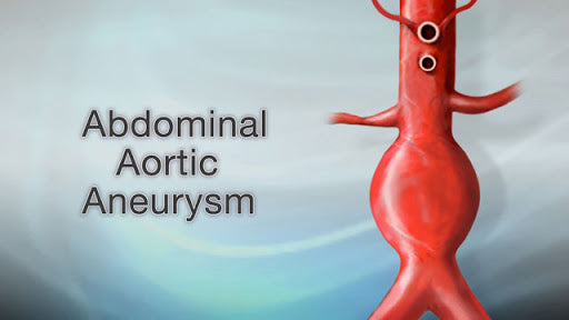 Abdominal aortic aneurysm