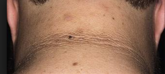 Acanthosis nigricans