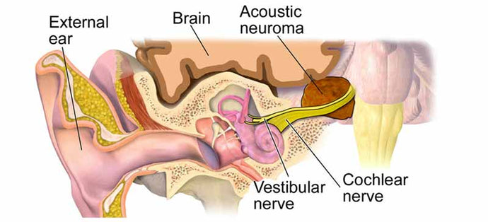 Acoustic neuroma (vestibular Schwannoma)