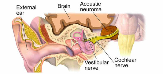 Acoustic neuroma (vestibular Schwannoma)