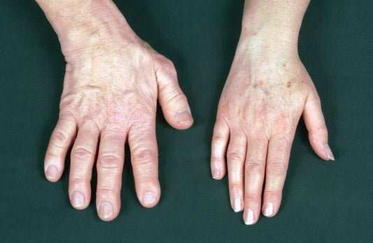 Acromegaly