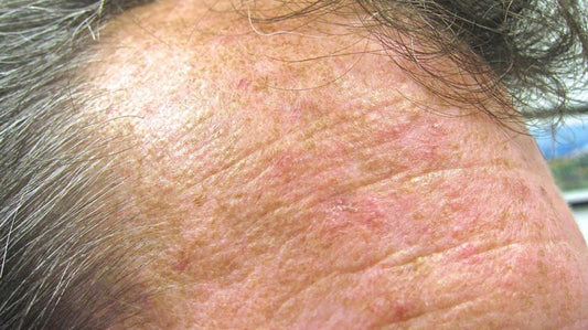 Actinic keratoses (solar keratoses)