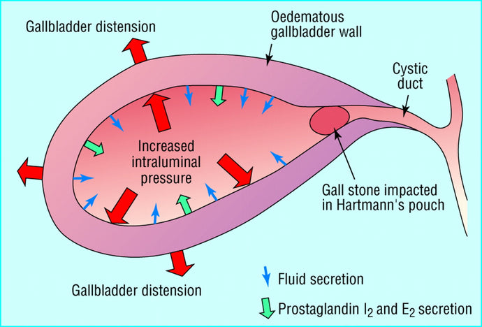 Acute cholecystitis