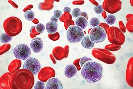 Acute lymphoblastic leukaemia