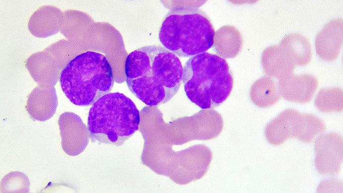 Acute myeloid leukaemia