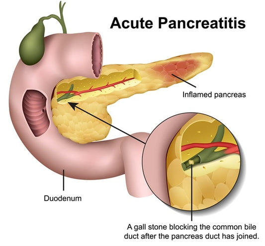 Acute pancreatitis