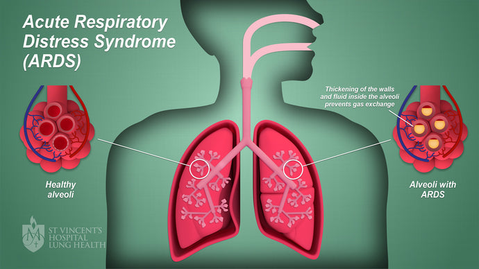 Acute respiratory distress syndrome