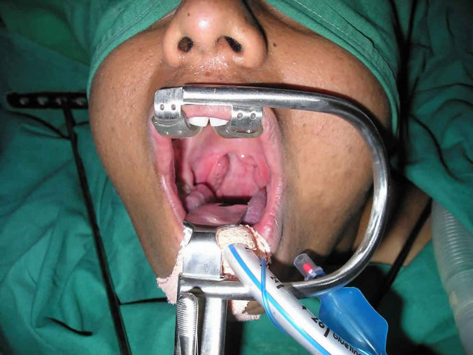 Adenoidectomy