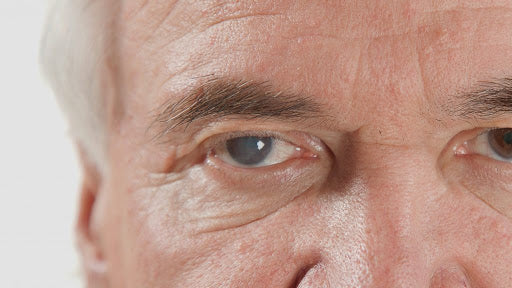 Age-related cataracts