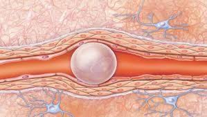 Air or gas embolism