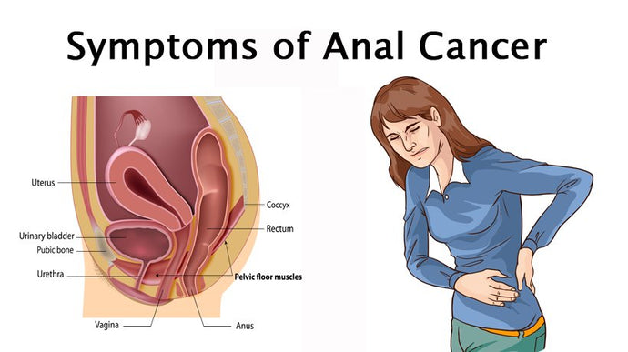 Anal cancer