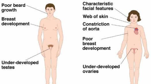 Androgen insensitivity syndrome