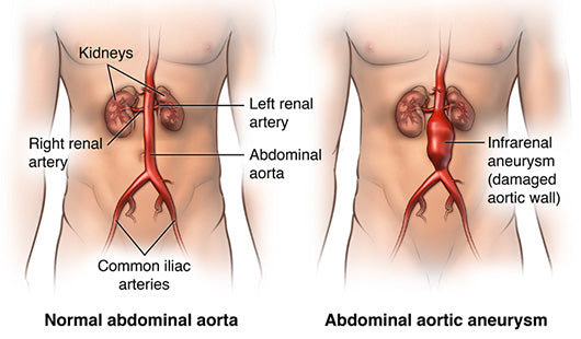 Aneurysm (abdominal aortic)