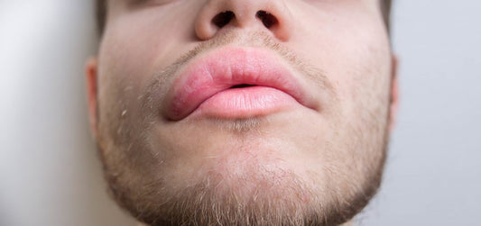 Angioedema