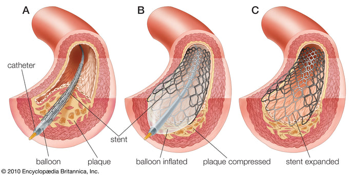 Angioplasty