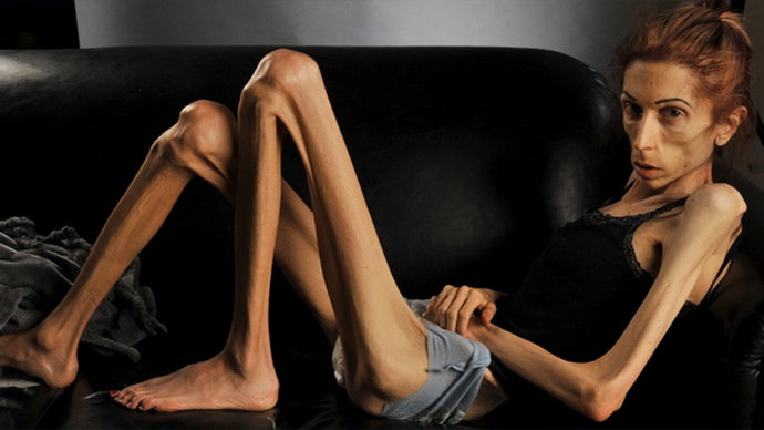 Anorexia