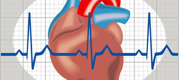 Arrhythmia