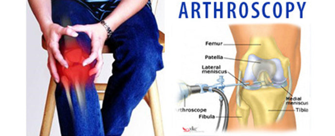 Arthroscopy