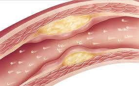 Atherosclerosis (arteriosclerosis)