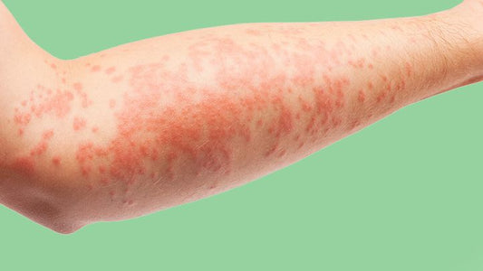 Atopic eczema