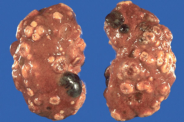 Autosomal dominant polycystic kidney disease