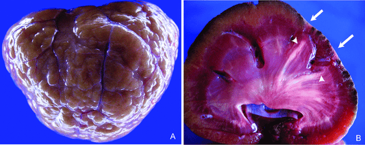 Autosomal recessive polycystic kidney disease