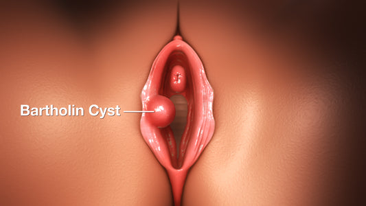 Bartholin's cyst