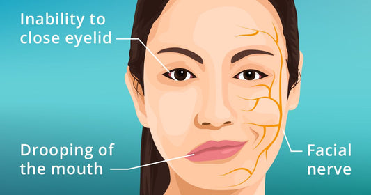 Bell's palsy