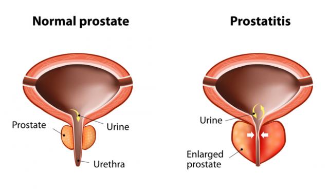 Benign prostate enlargement