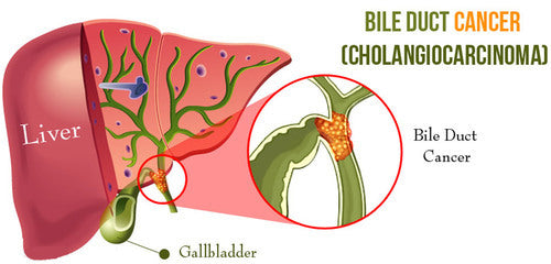 Bile duct cancer (cholangiocarcinoma)