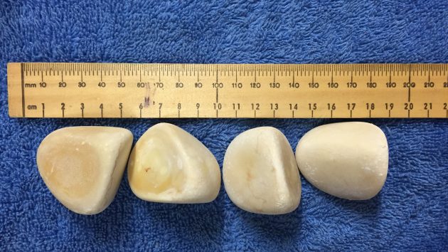 Bladder stones (urinary lithiasis)