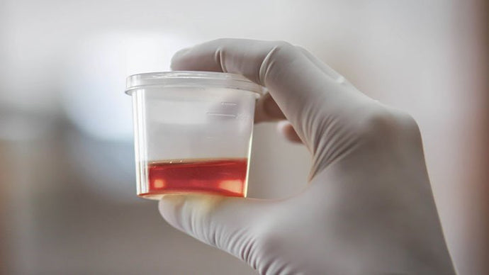 Blood in urine (hematuria)