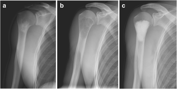 Bone cyst