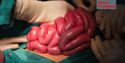 Bowel transplant