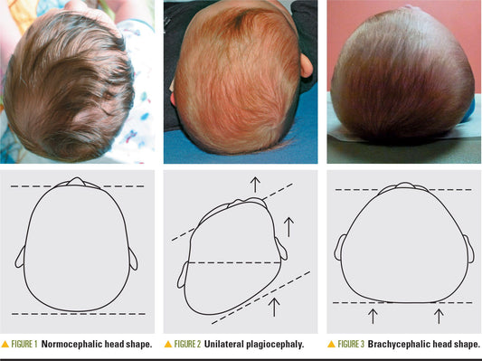 Brachycephaly and plagiocephaly