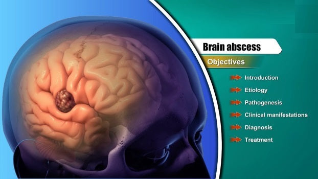 Brain abscess