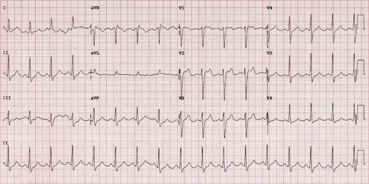 Brugada syndrome