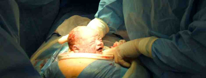 Caesarean section