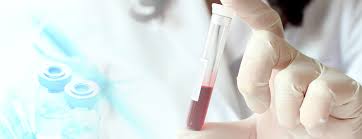 Carcinoembryonic antigen (CEA) test