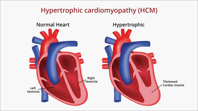 Cardiomyopathy