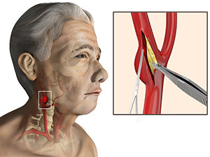 Carotid endarterectomy