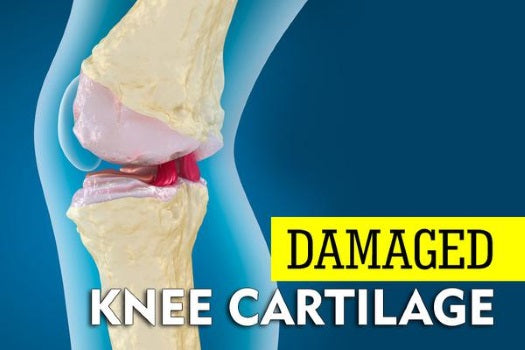 Cartilage damage