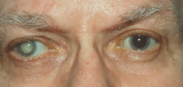 Cataracts (age-related)