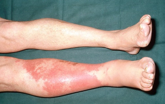 Cellulitis