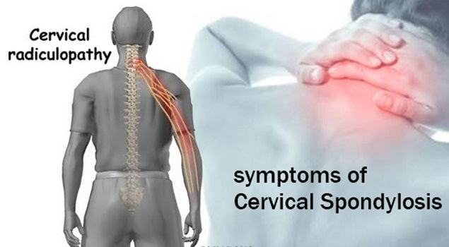 Cervical spondylosis