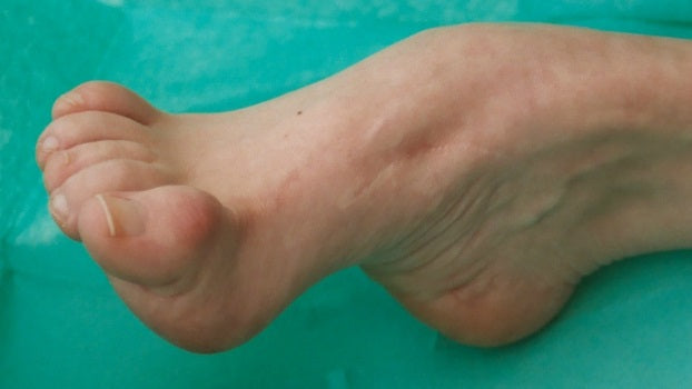 Charcot-Marie-Tooth disease