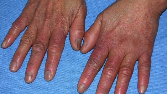 Chilblains