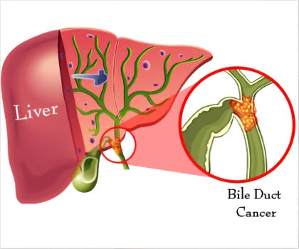 Cholangiocarcinoma